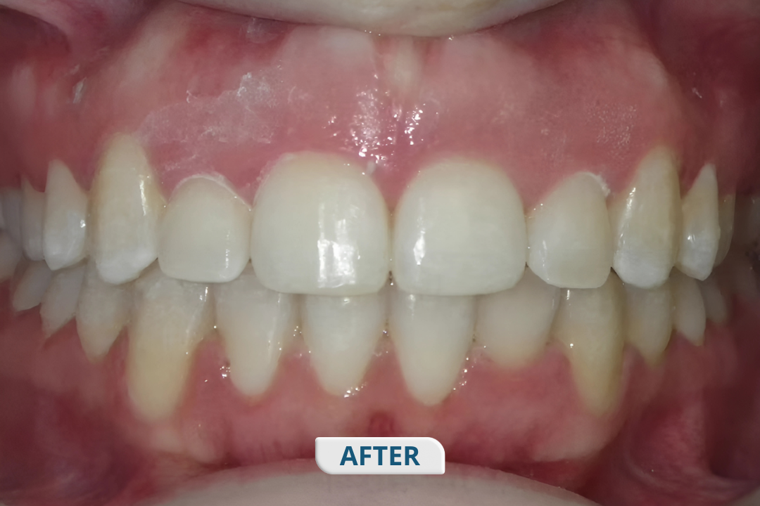 After treatment at Namira Oro Dental Care